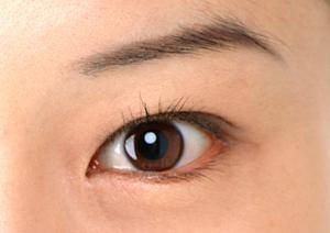 子宮頚部上皮内癌のレーザーでの切除